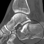 Ankle fracture 150x150