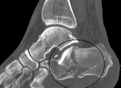 Ankle Fracture