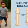Blount’s Disease