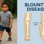 Bount disease 150x150