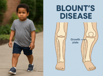 Blount’s Disease