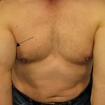 Bicepstendon10 150x150