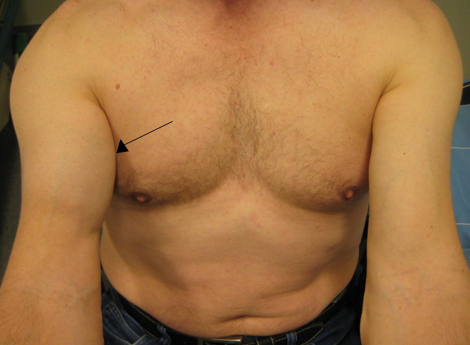 Bicepstendon10 scaled