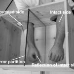 Phantom limb 150x150