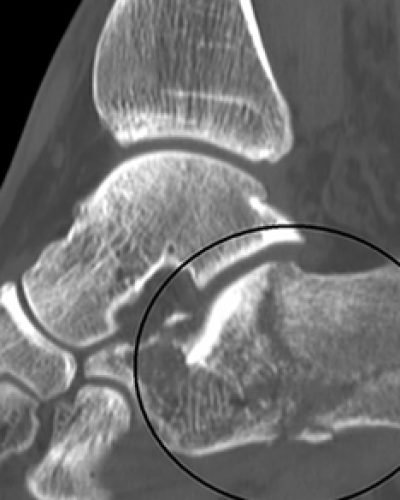 ankle-fracture